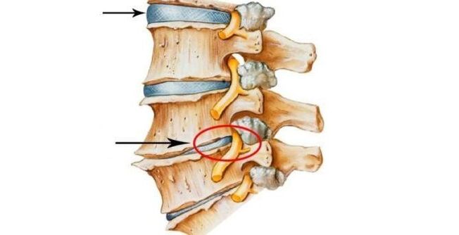 zdrav i oštećen disk kralježnice s cervikalnom osteohondrozo
