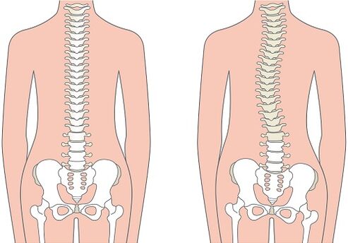 Bol u donjem dijelu leđa zbog deformacije kralježnice kao što je skolioza