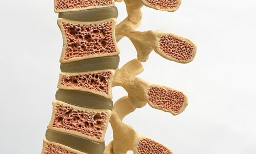 Osteoporoza je jedan od uzroka bolova u donjem dijelu leđa