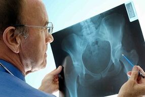 Artroza zgloba kuka na x -ray