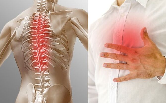 Torakalna osteohondroza i bol u prsima
