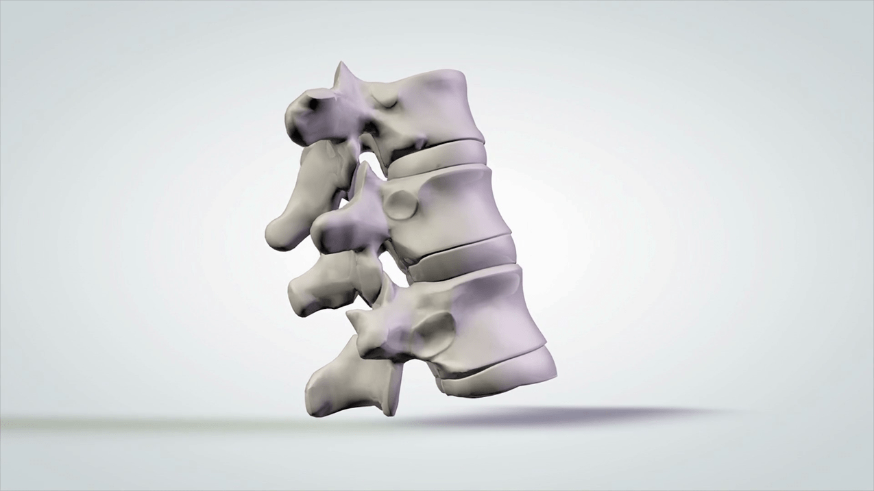oštećenje kralježnice zbog cervikalne osteohondroze