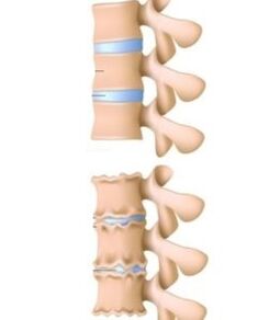 uzroci osteohondroze